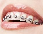 Фиксна протеза за зубе- за лепши и здравији осмех