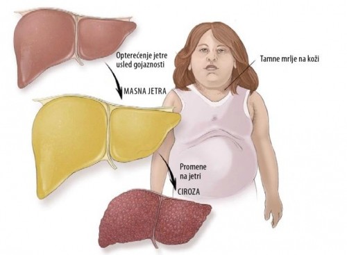 Masna jetra - simptomi i lečenje