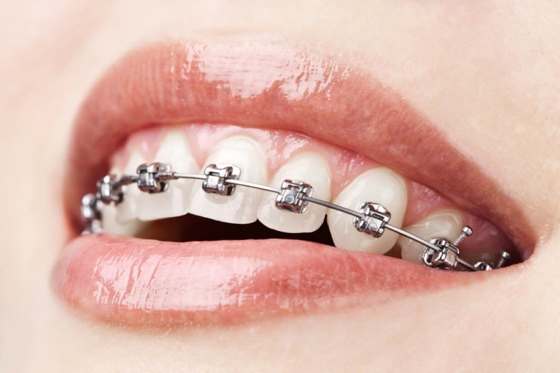 fisna proteza za zube