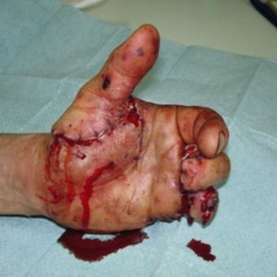 Одсечен му прст: Петарда му експлодирала у руци
