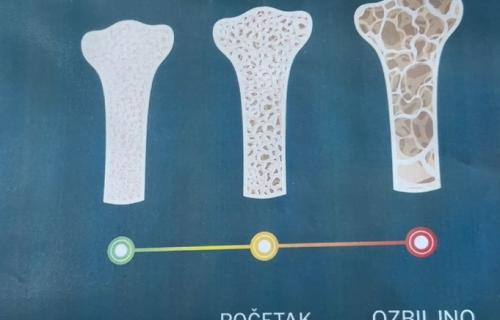 Остеопороза се често развија неприметно, без јасних симптома, а у каснијој фази може довести до прелома и нарушеног квалитета живота. Проверите здравље својих костију: Дом здравља Ниш омогућава дензитометрију без заказивања