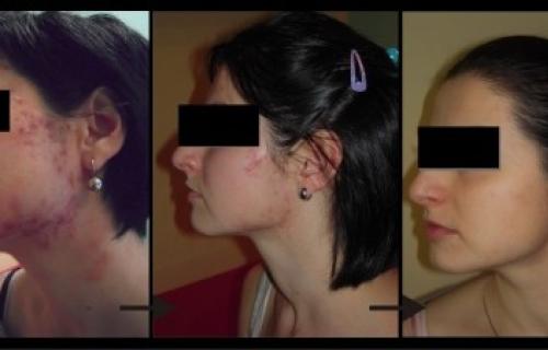 Acne vulgaris