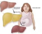 Masna jetra - simptomi i lečenje