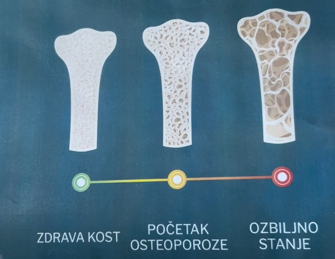 Proverite zdravlje svojih kostiju: Dom zdravlja Niš omogućava denzitometriju bez zakazivanja