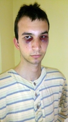 Krvavo: Studentu od batina umalo izbijene oči
